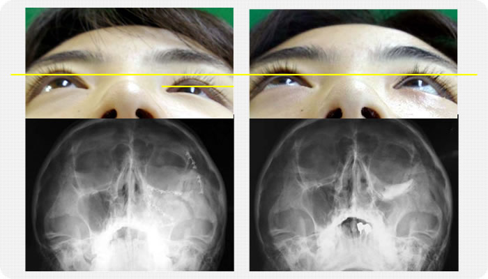 眼窩 底 骨折 と は