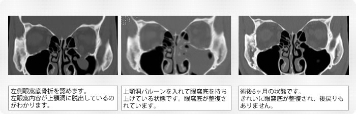 眼窩 底 骨折 と は