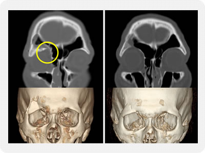 底 骨折 と は 眼窩