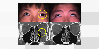 眼のまわりの骨折｜眼形成外科｜診療のご案内｜琉球大学病院 形成外科