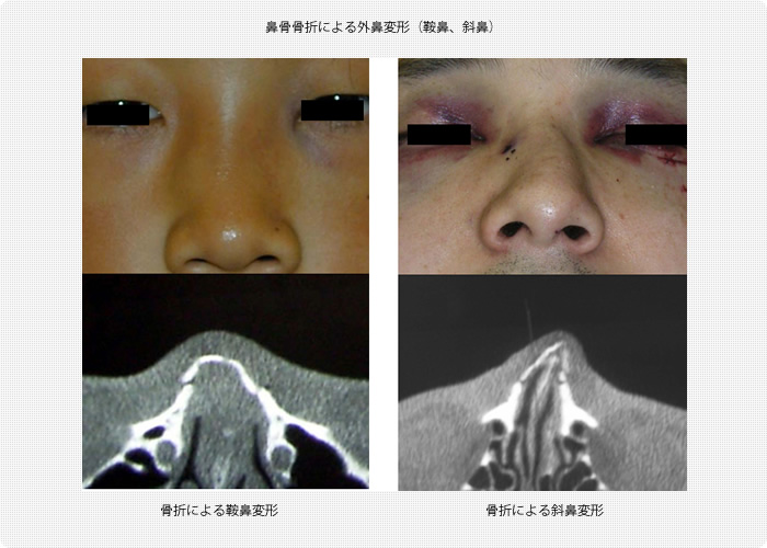 鼻骨骨折による外鼻変形（鞍鼻、斜鼻）