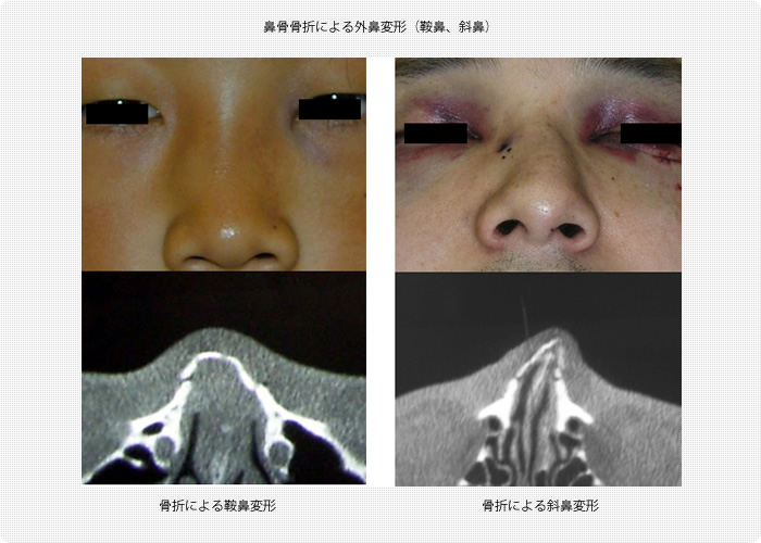 鼻 の 骨 が 折れ たら