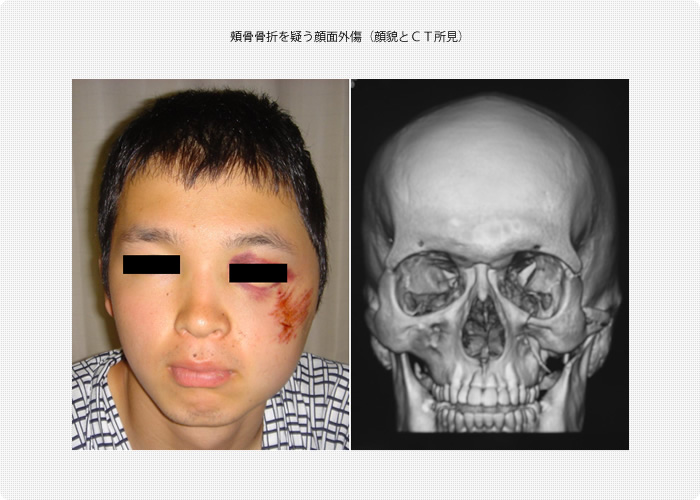 頬骨骨折を疑う顔面外傷（顔貌とＣＴ所見）