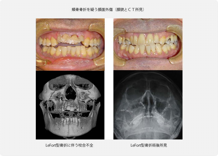 顎骨骨折に伴う咬合不全（咬合とＣＴ所見）