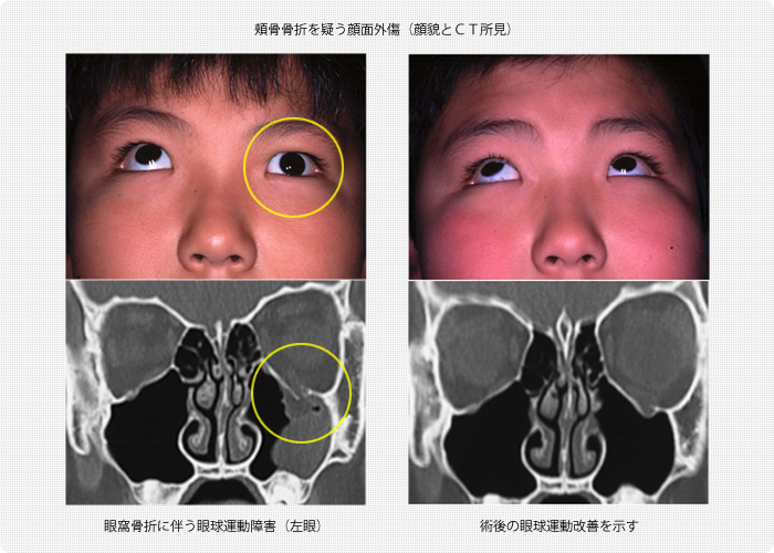眼窩骨折に伴う眼球運動障害（眼症状とＣＴ所見）