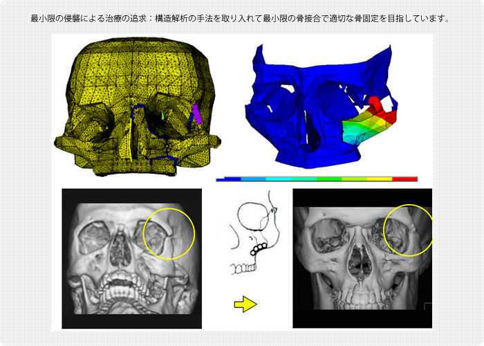 最小限の侵襲による治療の追求：構造解析の手法を取り入れて最小限の骨接合で適切な骨固定を目指しています。