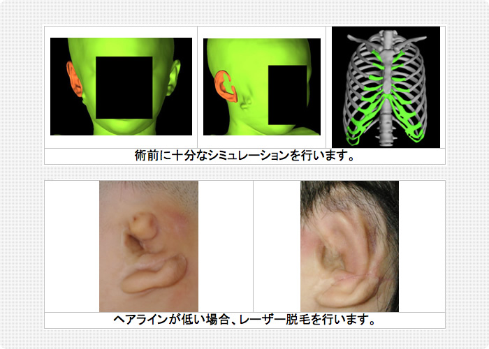 小耳症の治療