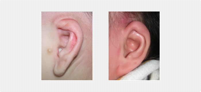 埋没耳の治療