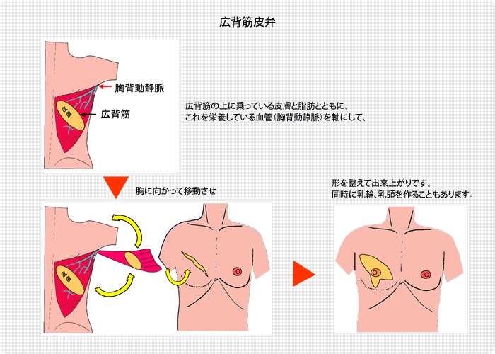 乳房再建｜診療のご案内｜琉球大学病院 形成外科