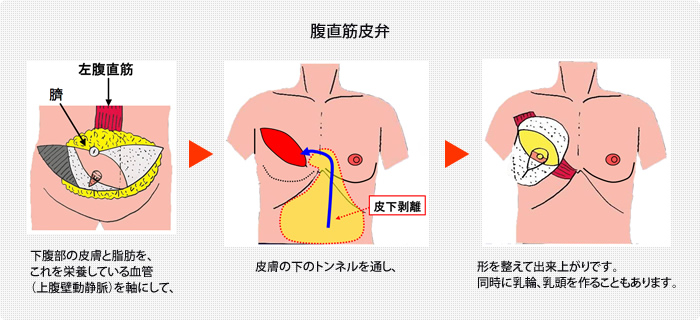 腹直筋皮弁