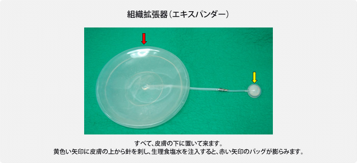 人工物を用いた再建