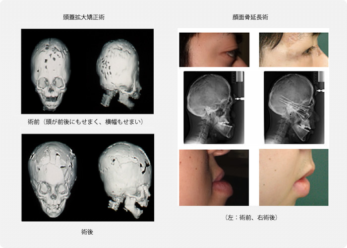 頭蓋骨・顔面骨の変形｜診療のご案内｜琉球大学病院 形成外科