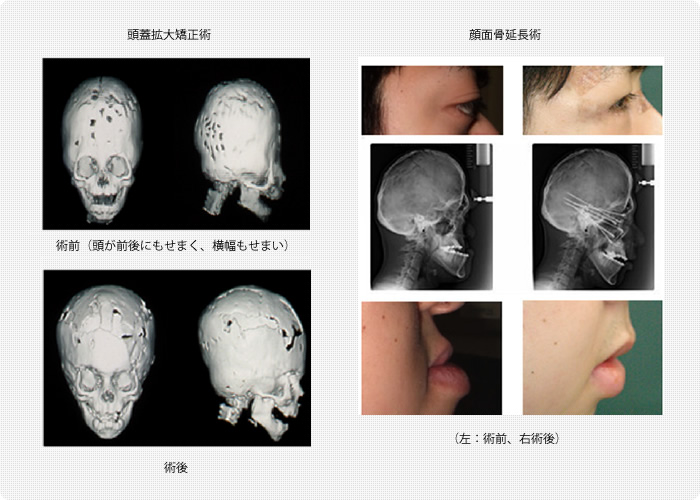 頭蓋拡大矯正術、顔面骨延長術