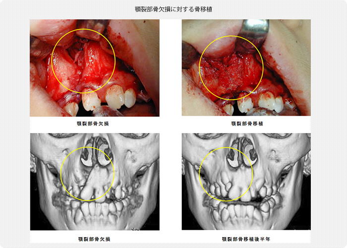 顎裂部骨欠損に対する骨移植