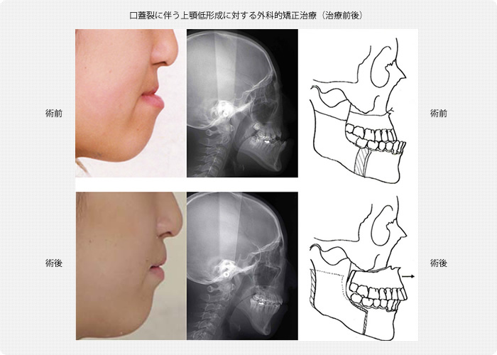 口蓋裂に伴う上顎低形成に対する外科的矯正治療（治療前後）に対する骨移植