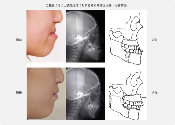 頭蓋骨・顔面骨の変形｜診療のご案内｜琉球大学病院 形成外科