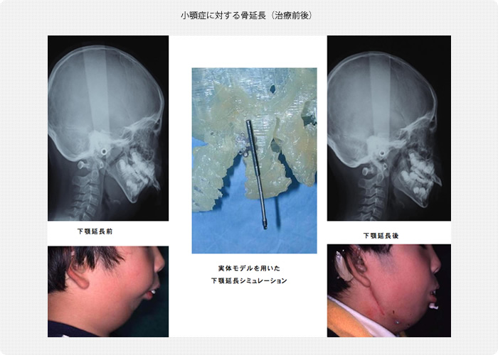 小顎症に対する骨延長治療