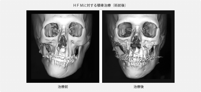 ＨＦＭに対する顎骨治療（術前後）