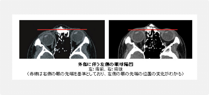 外傷に伴う眼球陥凹