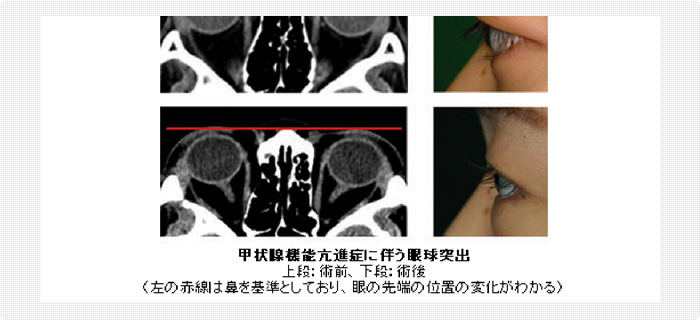 甲状腺機能亢進症に伴う眼球突出